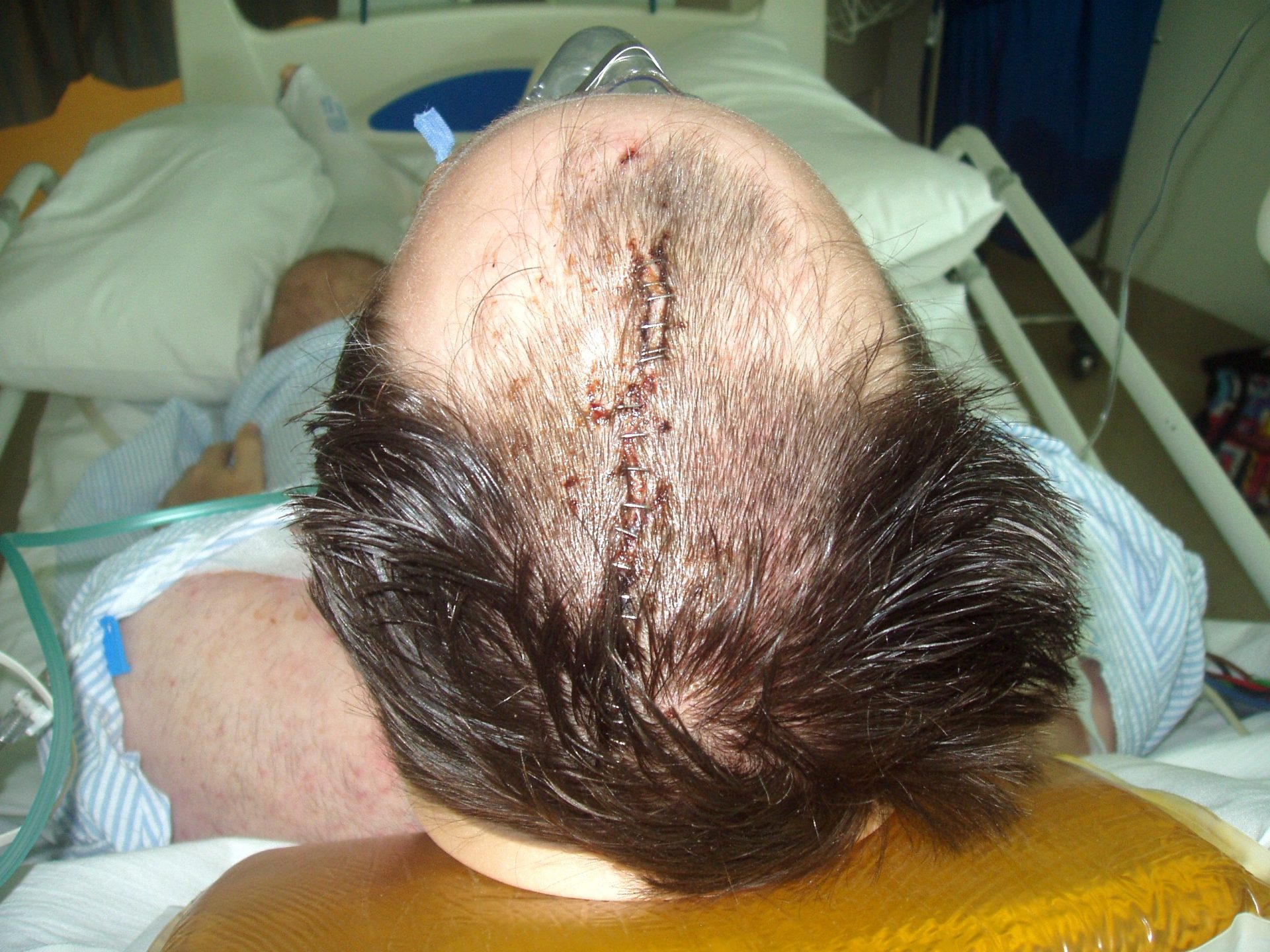 john's shaven head showing the split in his skull and the staples holding it together, no wonder there was a spinal cord injury