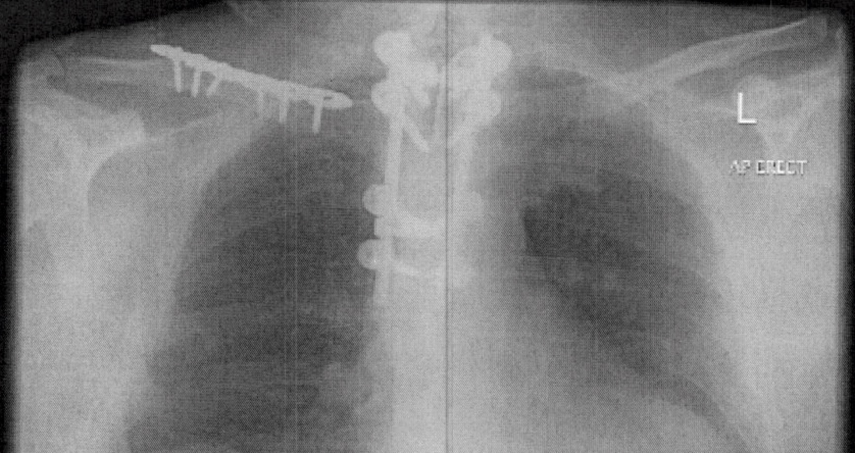 the xrays show metal work in the colllar bone and back around the level of the spinal cord injury